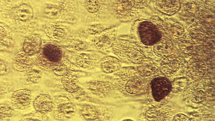 Epidemia de ETS en EE.UU. se ralentiza con la reducción de nuevos casos de sífilis y gonorrea